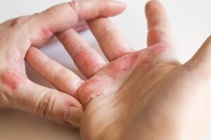 Perbedaan Jelas Antara Kusta dan Kista