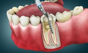 Waspadai Tanda Gigi Perlu Perawatan Saluran