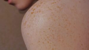 Penyebab dan Cara Mengatasi Chicken Skin Kulit Kasar